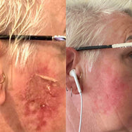 Lady's face after skin cancer treatment beside lady's face that is smooth and soft