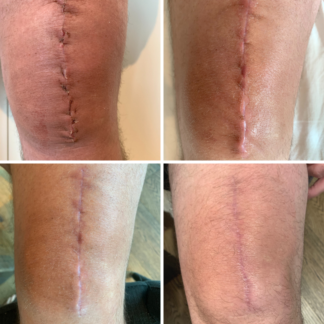 Knee scar progression after surgery 4 stages using golden 8 serum and soothing cream