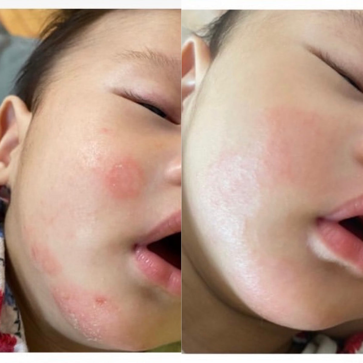 Baby's face with eczema beside baby's face with smooth soft skin